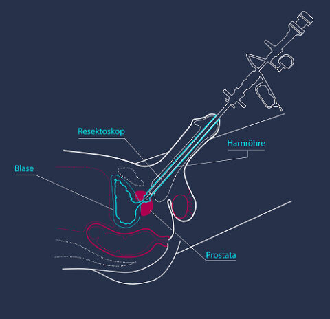 Schematische Darstellung der Resektoskopie: Das Resektoskop wird durch die Harnröhre eingeführt, Blase und Prostata sind angedeutet