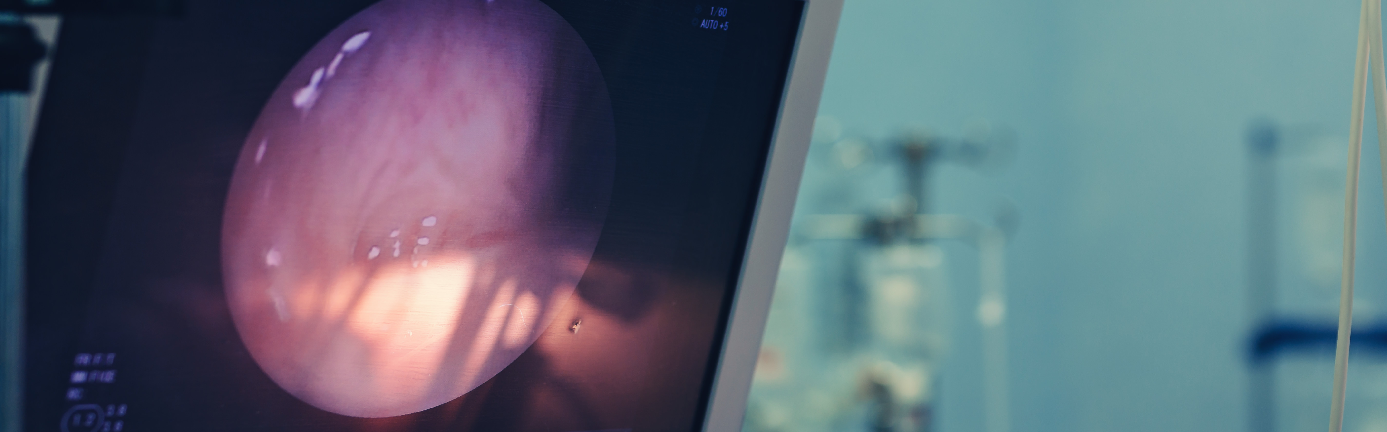 Blick durch das Resektoskop: Die Blasenschleimhaut wird live auf dem Monitor dargestellt